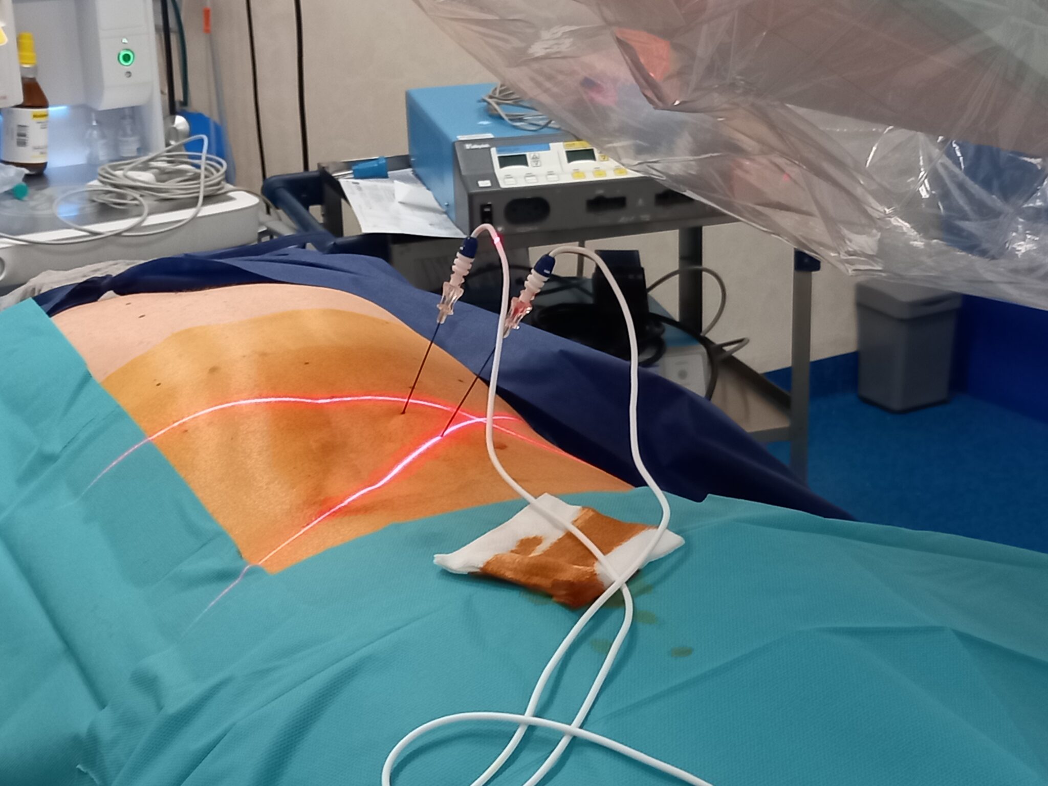Neurolyse par radiofréquence Centre anti douleur du Pacifique