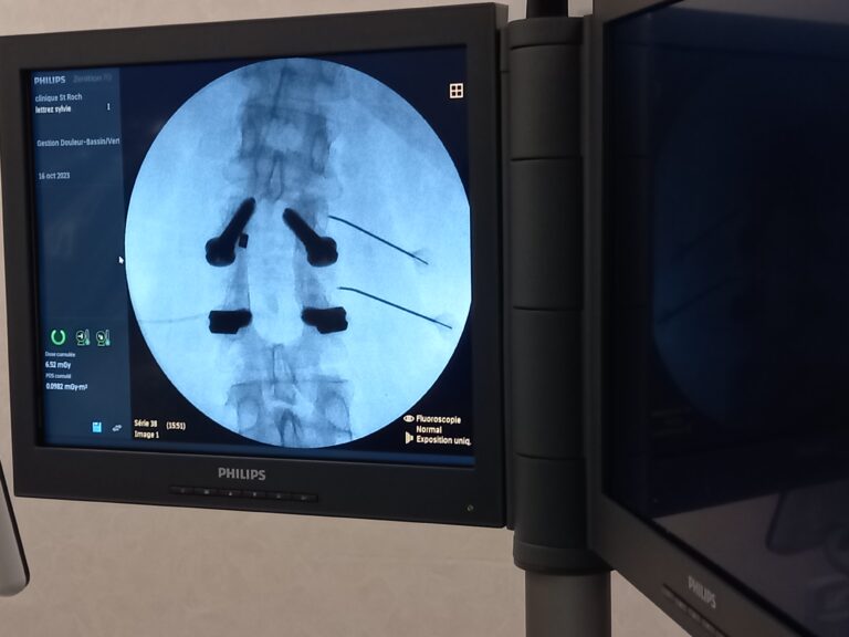 Neurolyse par radiofréquence Centre anti douleur du Pacifique